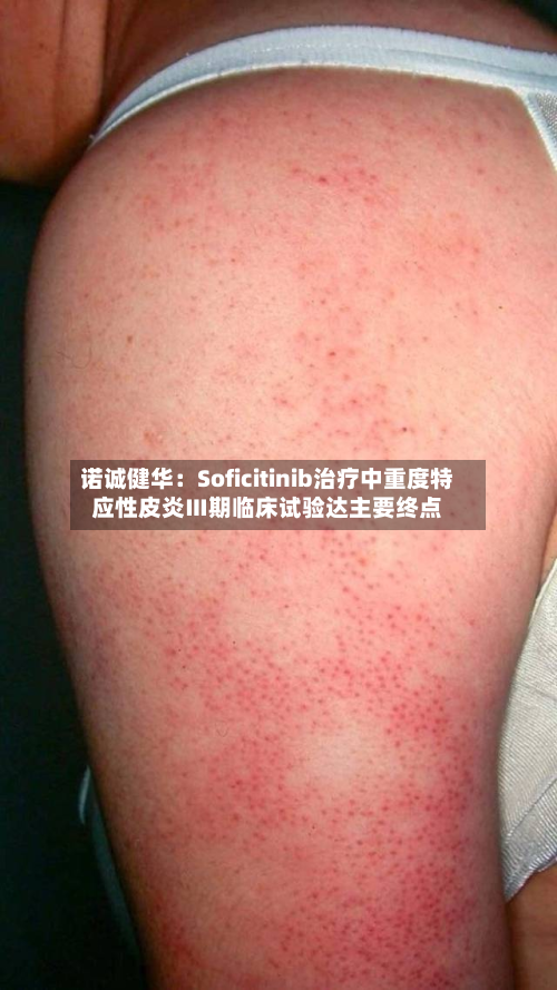 诺诚健华：Soficitinib治疗中重度特应性皮炎Ⅲ期临床试验达主要终点